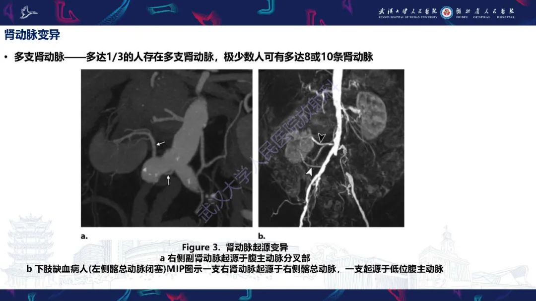 【PPT】肾动脉：解剖、病理及血管内治疗-5