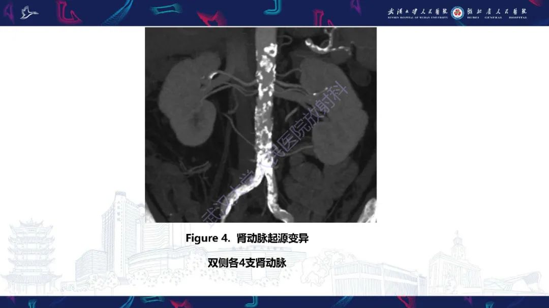 【PPT】肾动脉：解剖、病理及血管内治疗-6