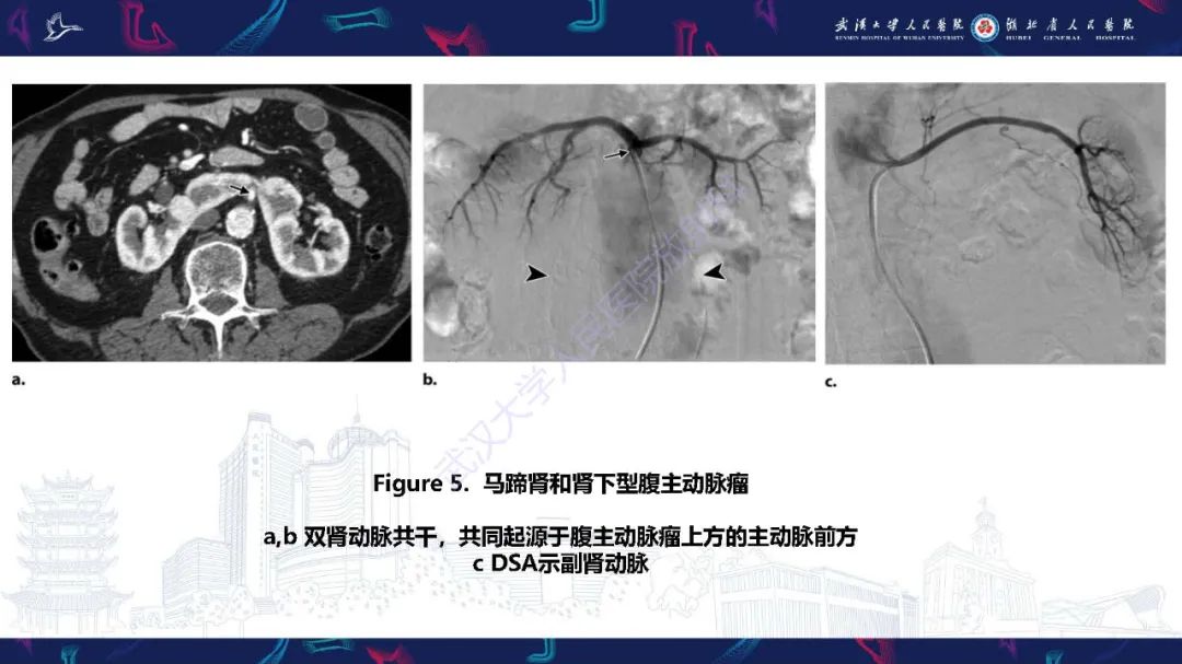【PPT】肾动脉：解剖、病理及血管内治疗-8