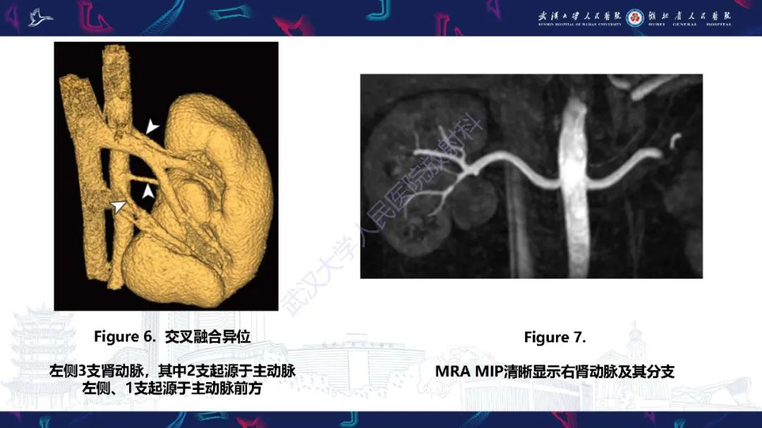 【PPT】肾动脉：解剖、病理及血管内治疗-9