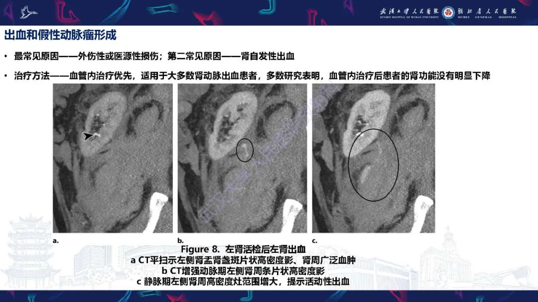【PPT】肾动脉：解剖、病理及血管内治疗-10