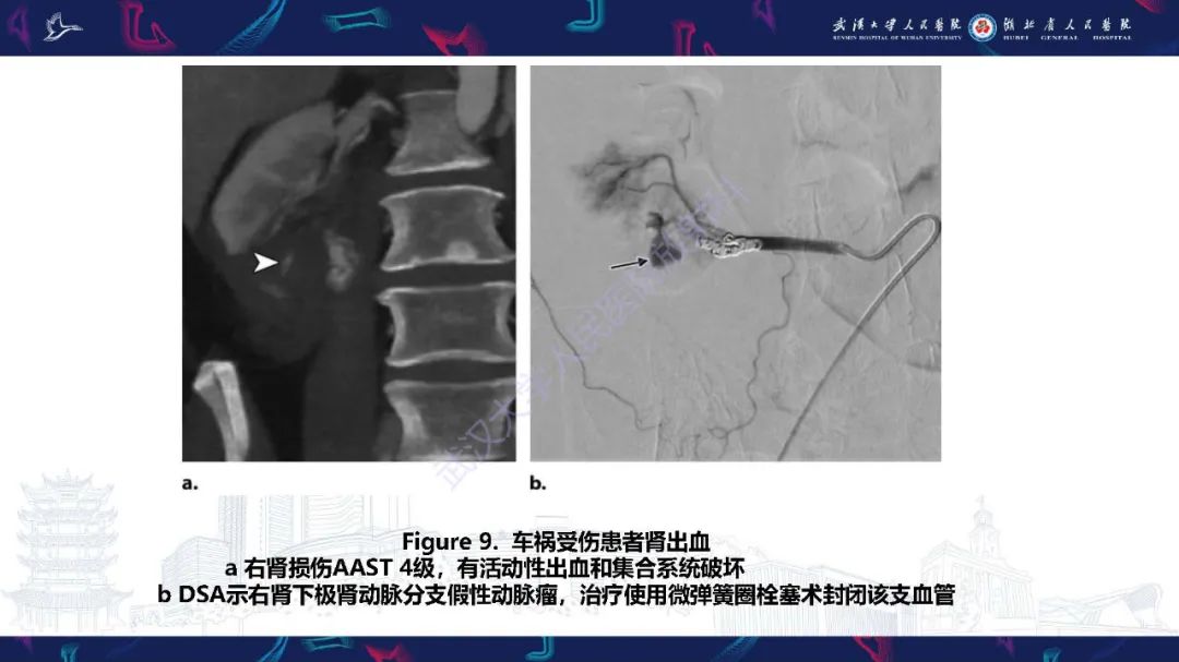 【PPT】肾动脉：解剖、病理及血管内治疗-12