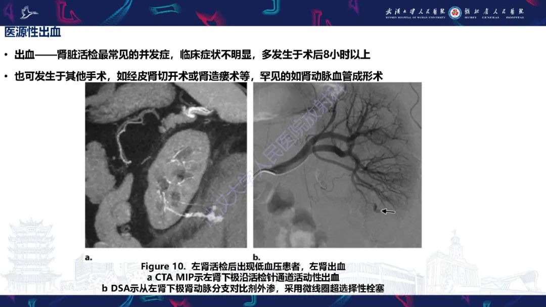 【PPT】肾动脉：解剖、病理及血管内治疗-13