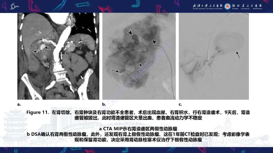 【PPT】肾动脉：解剖、病理及血管内治疗-14