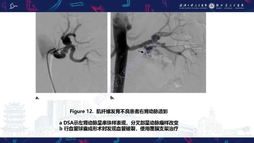 【PPT】肾动脉：解剖、病理及血管内治疗-15