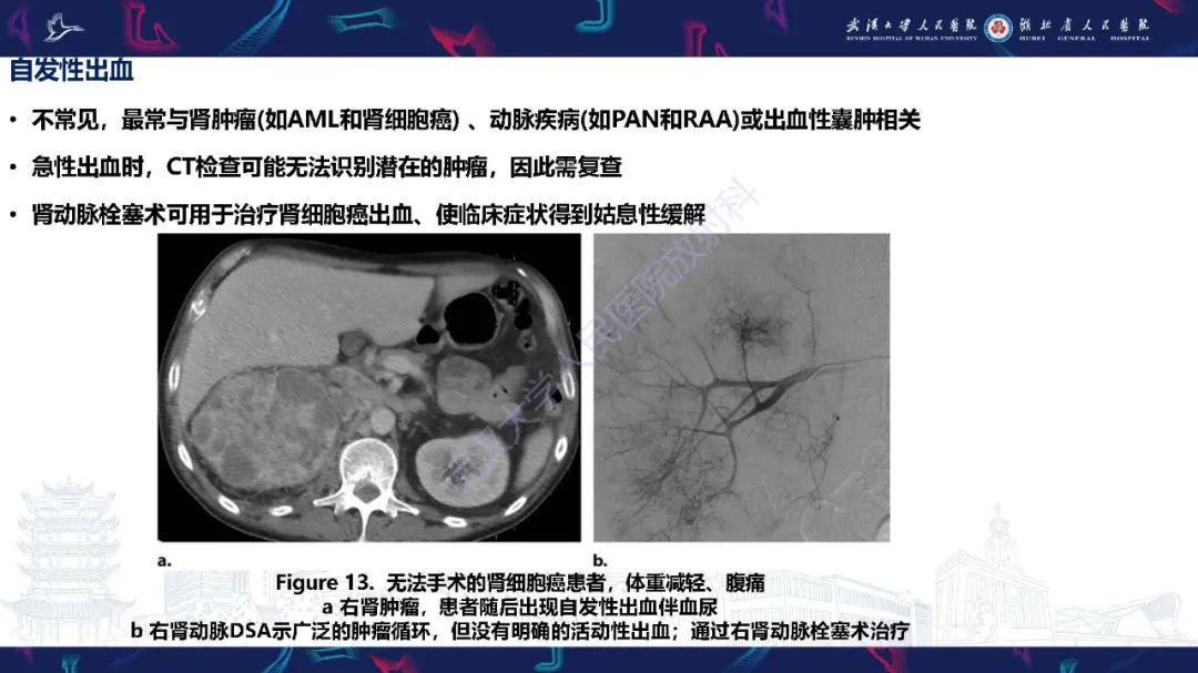 【PPT】肾动脉：解剖、病理及血管内治疗-16