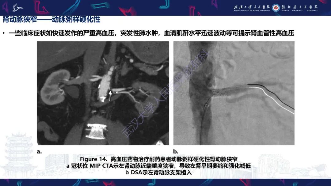 【PPT】肾动脉：解剖、病理及血管内治疗-17