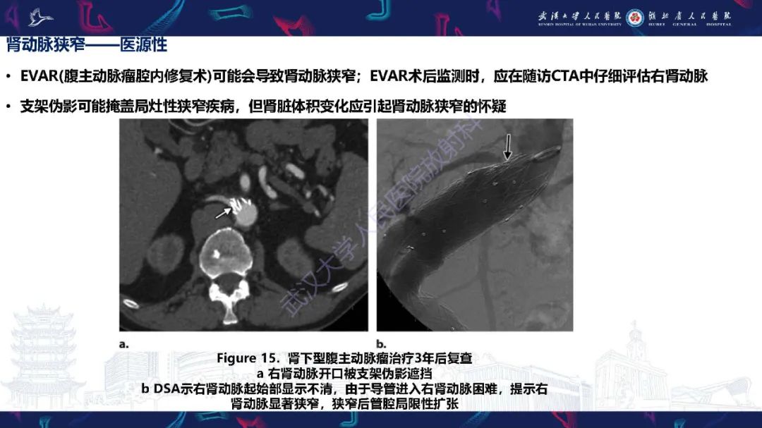 【PPT】肾动脉：解剖、病理及血管内治疗-18