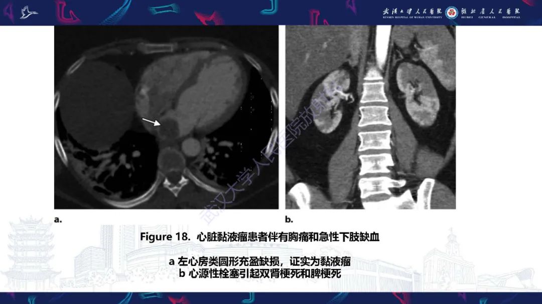 【PPT】肾动脉：解剖、病理及血管内治疗-21