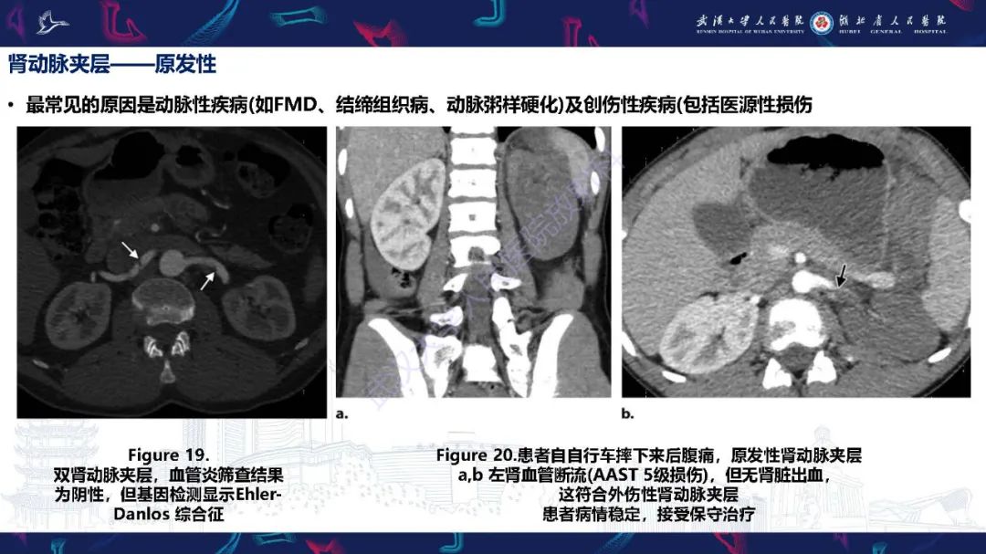 【PPT】肾动脉：解剖、病理及血管内治疗-22