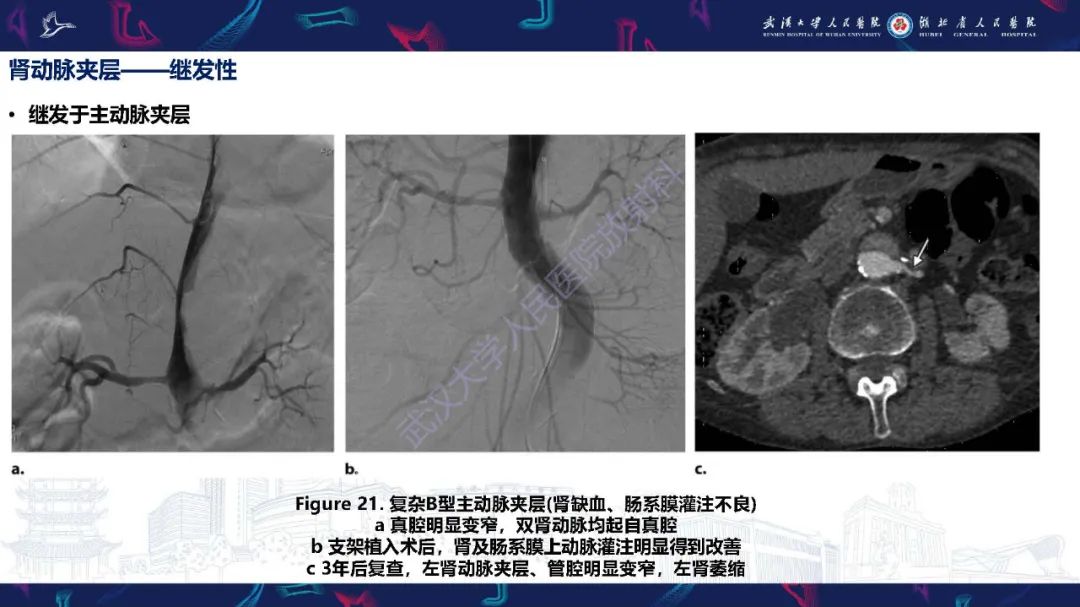 【PPT】肾动脉：解剖、病理及血管内治疗-23