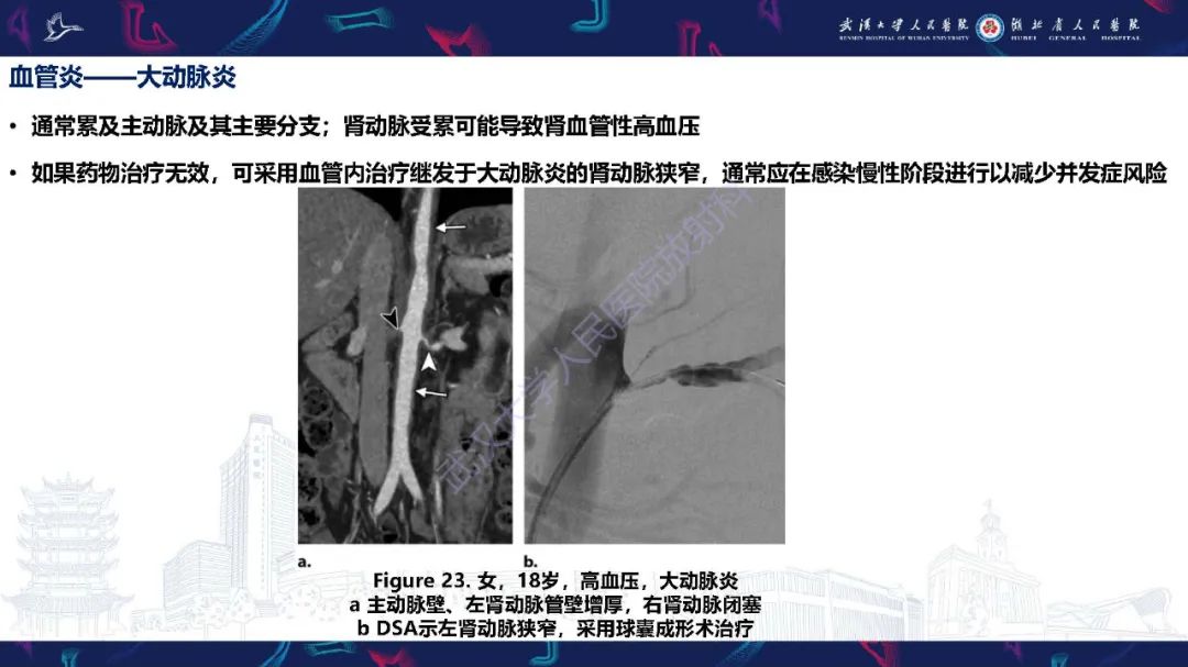 【PPT】肾动脉：解剖、病理及血管内治疗-25