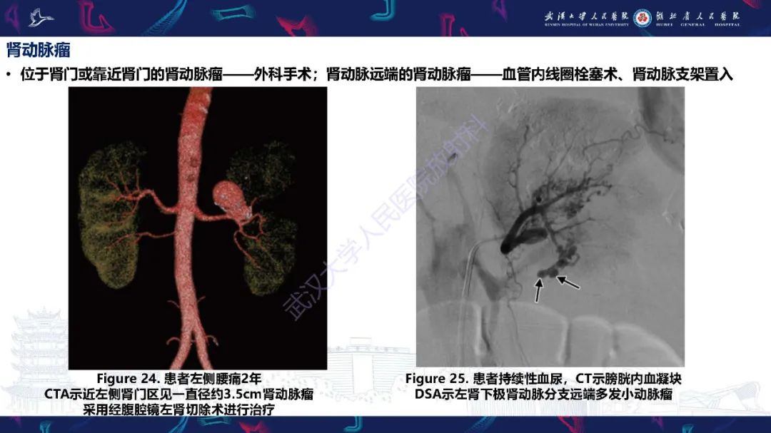 【PPT】肾动脉：解剖、病理及血管内治疗-26