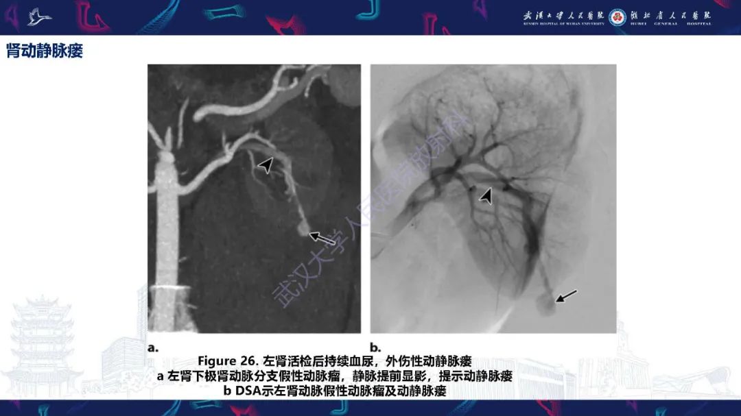 【PPT】肾动脉：解剖、病理及血管内治疗-27
