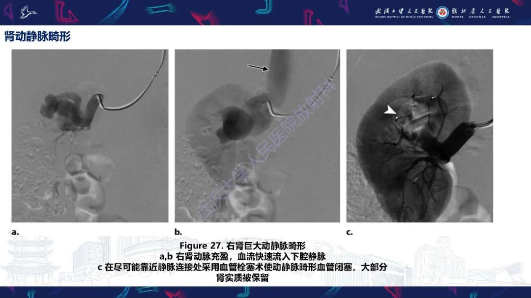 【PPT】肾动脉：解剖、病理及血管内治疗-28