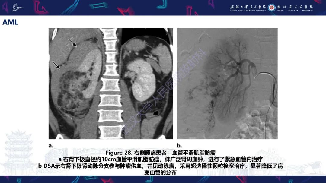【PPT】肾动脉：解剖、病理及血管内治疗-29