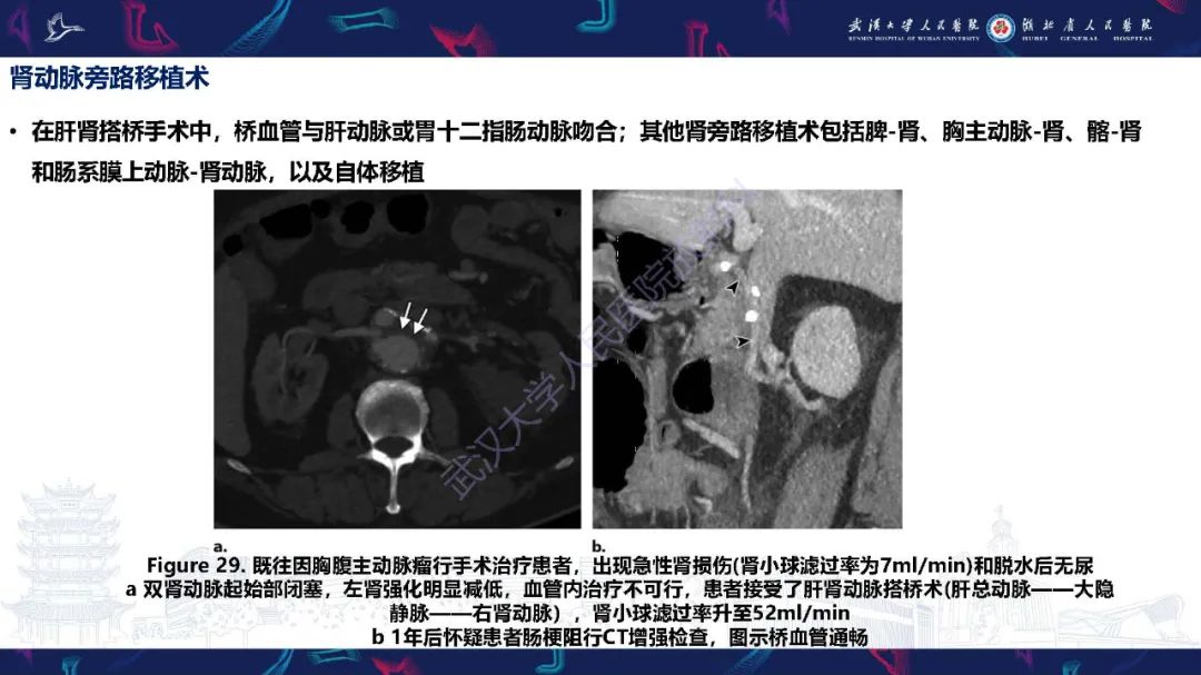 【PPT】肾动脉：解剖、病理及血管内治疗-30
