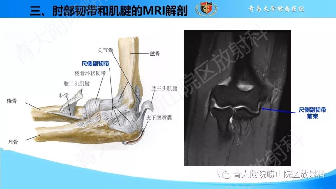 【PPT】肘部韧带和肌腱损伤的MRI诊断-14