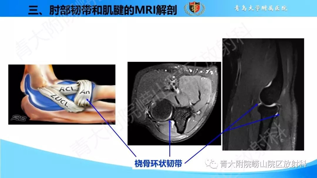 【PPT】肘部韧带和肌腱损伤的MRI诊断-16