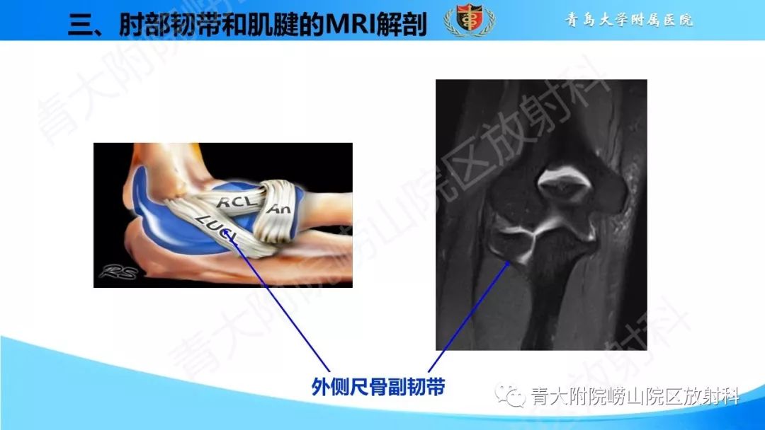 【PPT】肘部韧带和肌腱损伤的MRI诊断-18