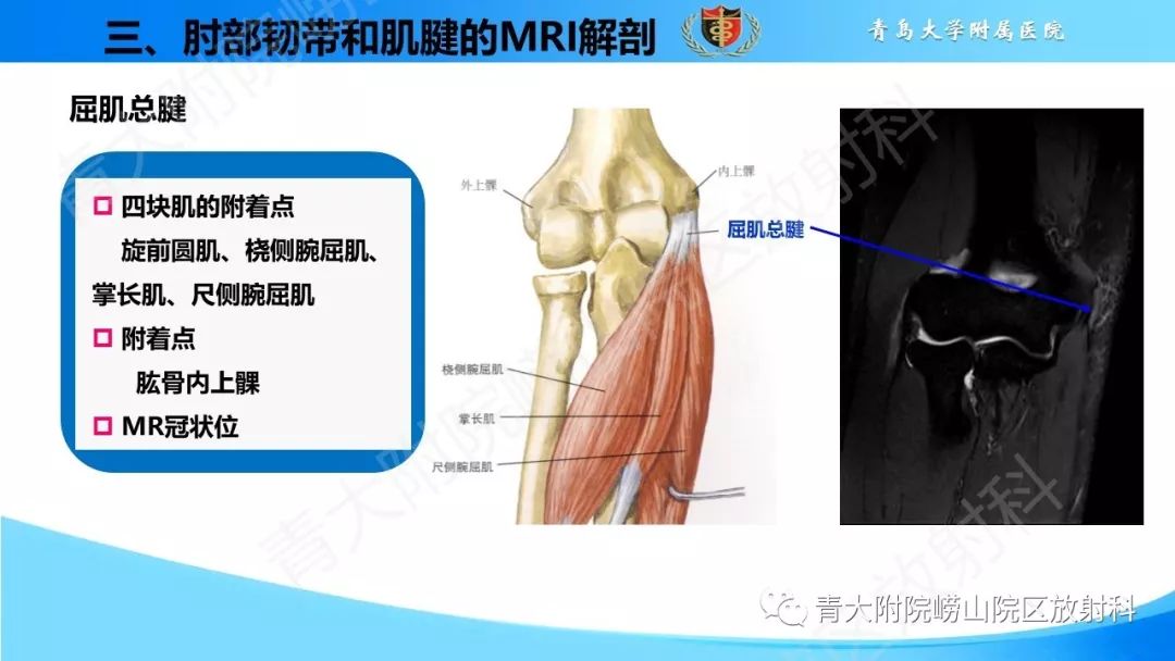 【PPT】肘部韧带和肌腱损伤的MRI诊断-19