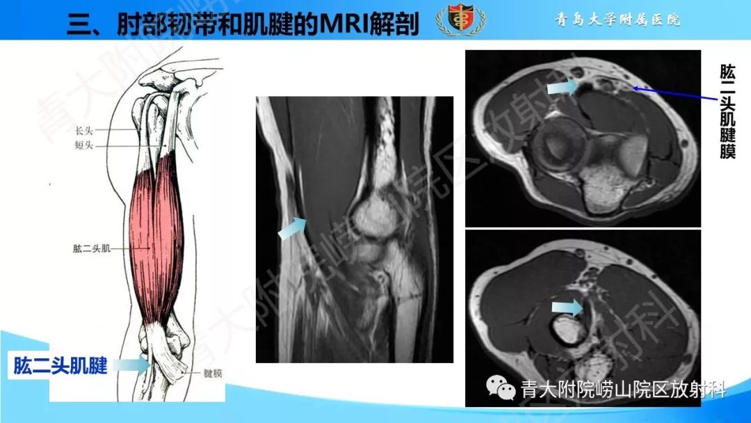 【PPT】肘部韧带和肌腱损伤的MRI诊断-21