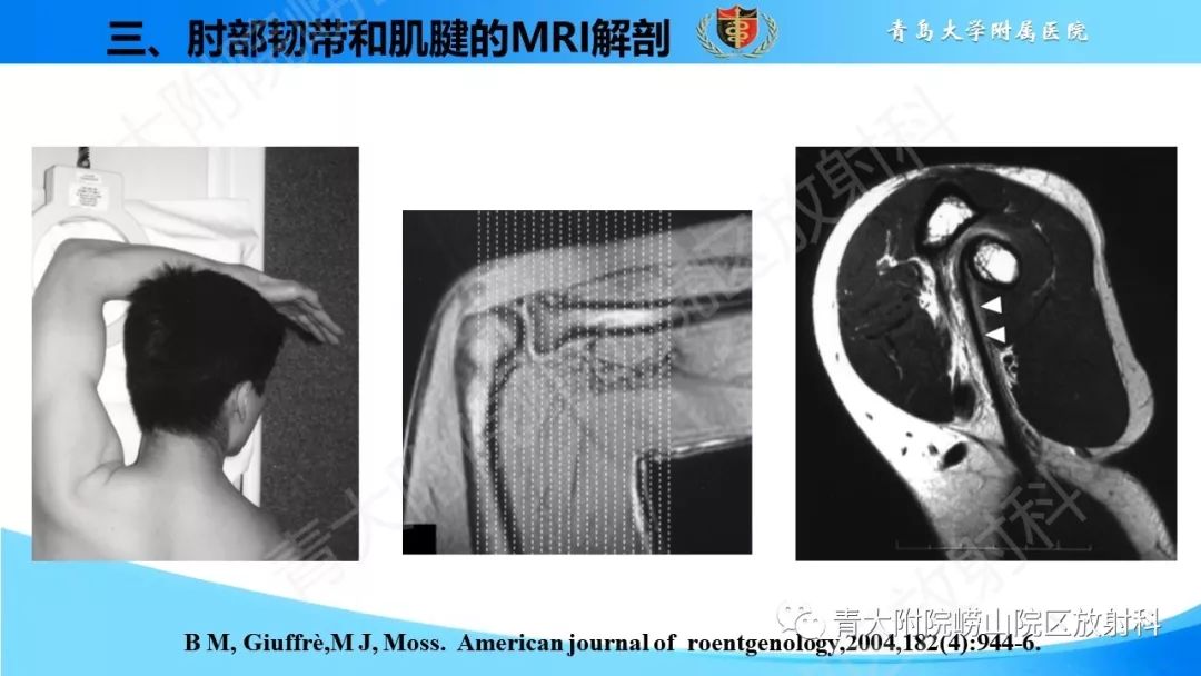 【PPT】肘部韧带和肌腱损伤的MRI诊断-22