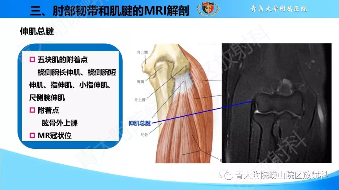 【PPT】肘部韧带和肌腱损伤的MRI诊断-24