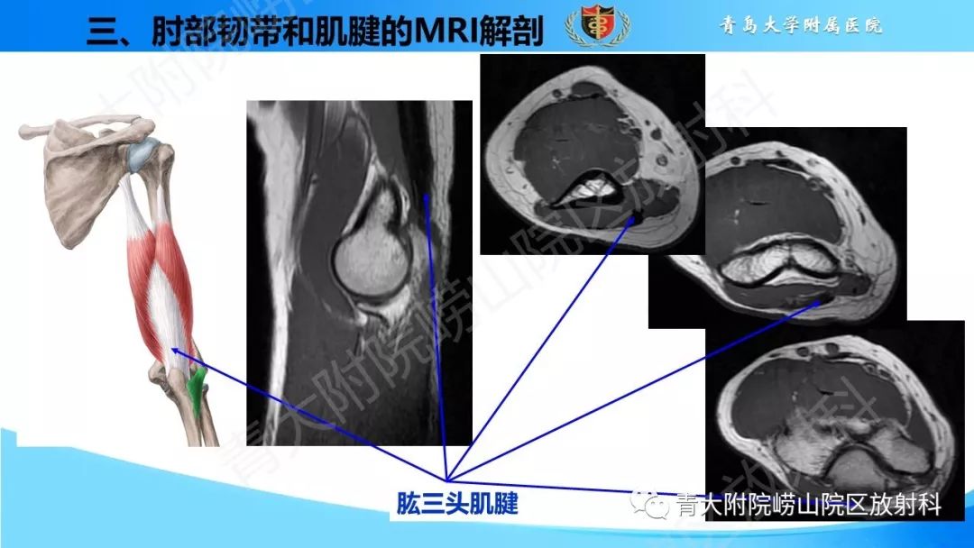 【PPT】肘部韧带和肌腱损伤的MRI诊断-26