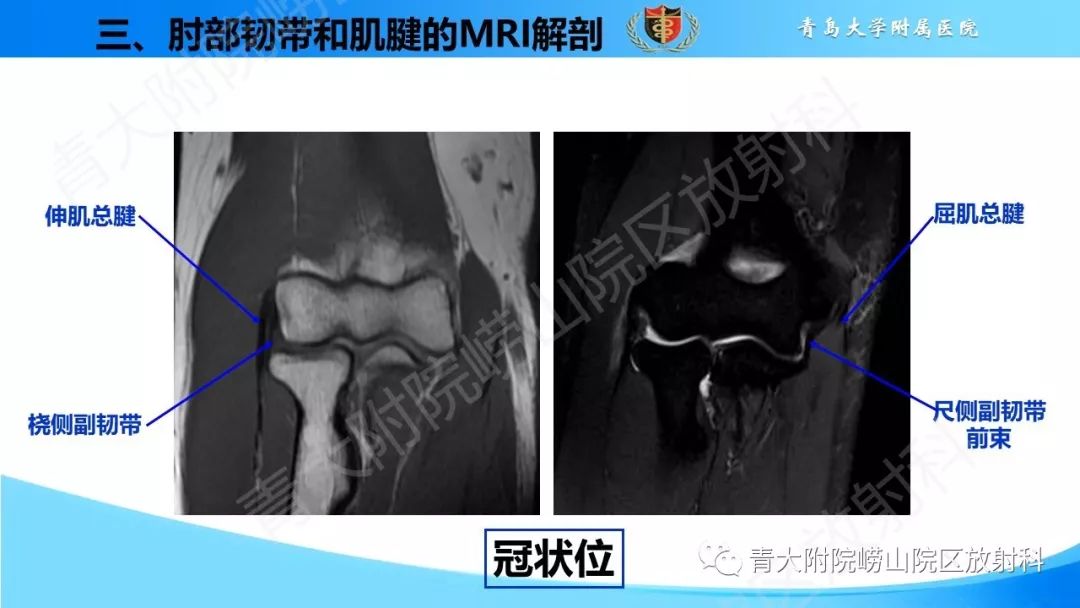 【PPT】肘部韧带和肌腱损伤的MRI诊断-27