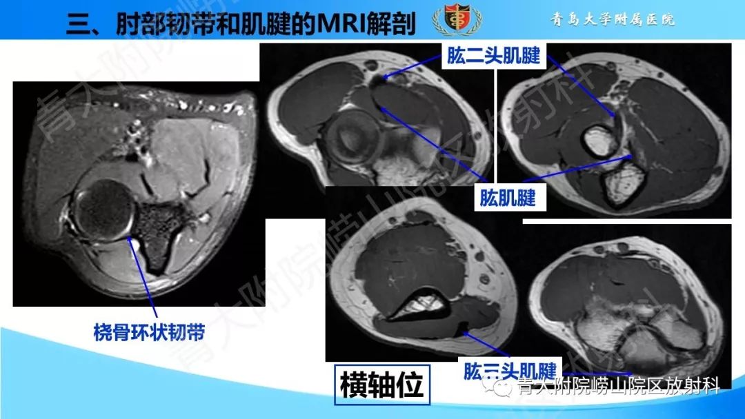 【PPT】肘部韧带和肌腱损伤的MRI诊断-28