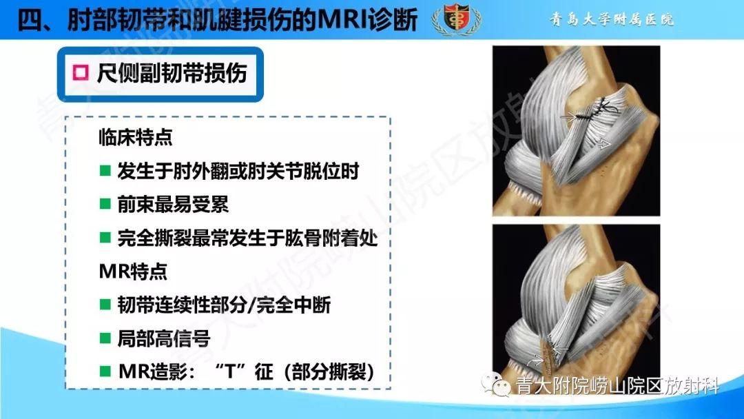 【PPT】肘部韧带和肌腱损伤的MRI诊断-30