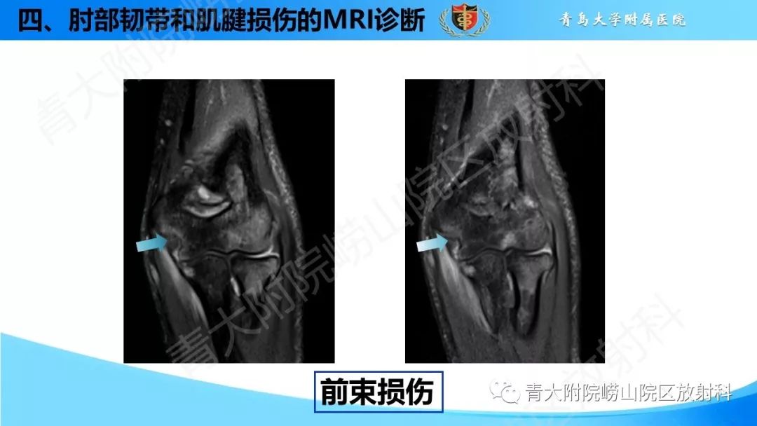 【PPT】肘部韧带和肌腱损伤的MRI诊断-31