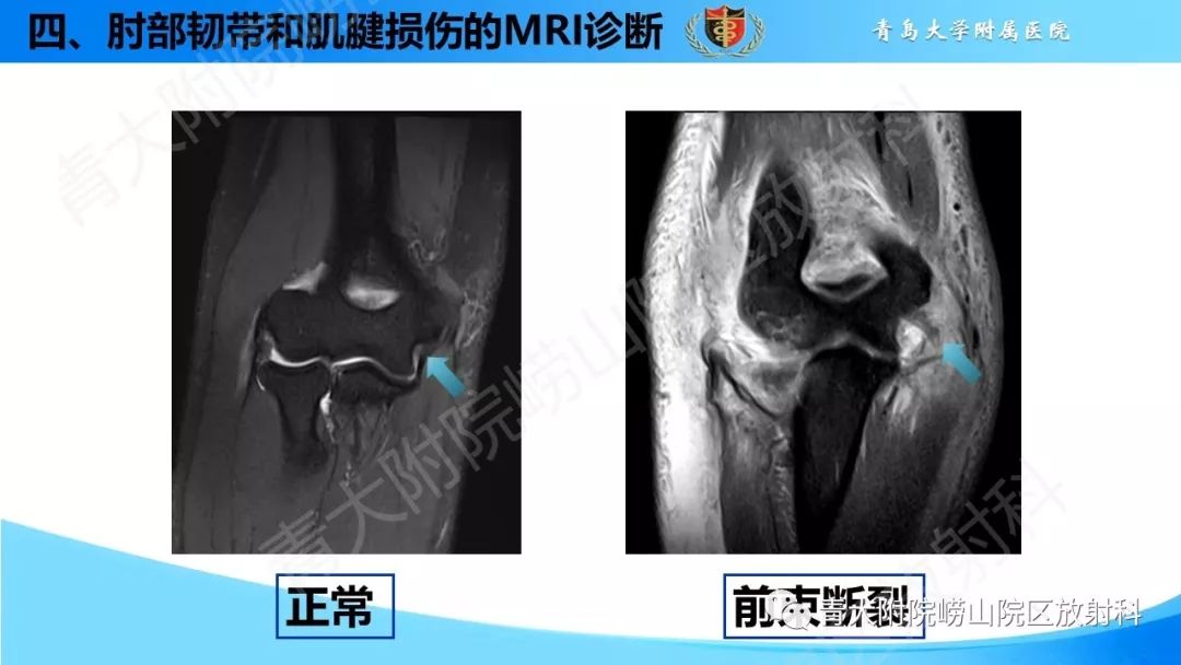 【PPT】肘部韧带和肌腱损伤的MRI诊断-32