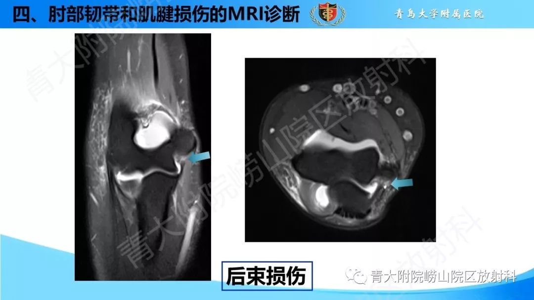 【PPT】肘部韧带和肌腱损伤的MRI诊断-33