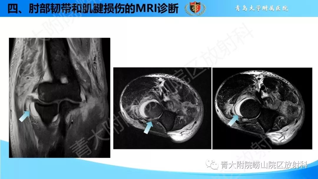 【PPT】肘部韧带和肌腱损伤的MRI诊断-35