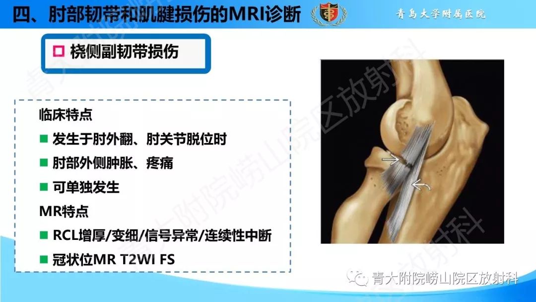 【PPT】肘部韧带和肌腱损伤的MRI诊断-36