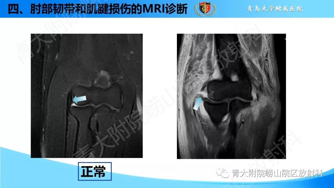 【PPT】肘部韧带和肌腱损伤的MRI诊断-37