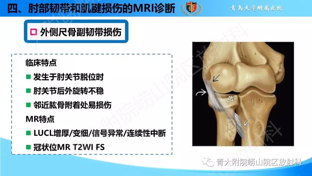 【PPT】肘部韧带和肌腱损伤的MRI诊断-38