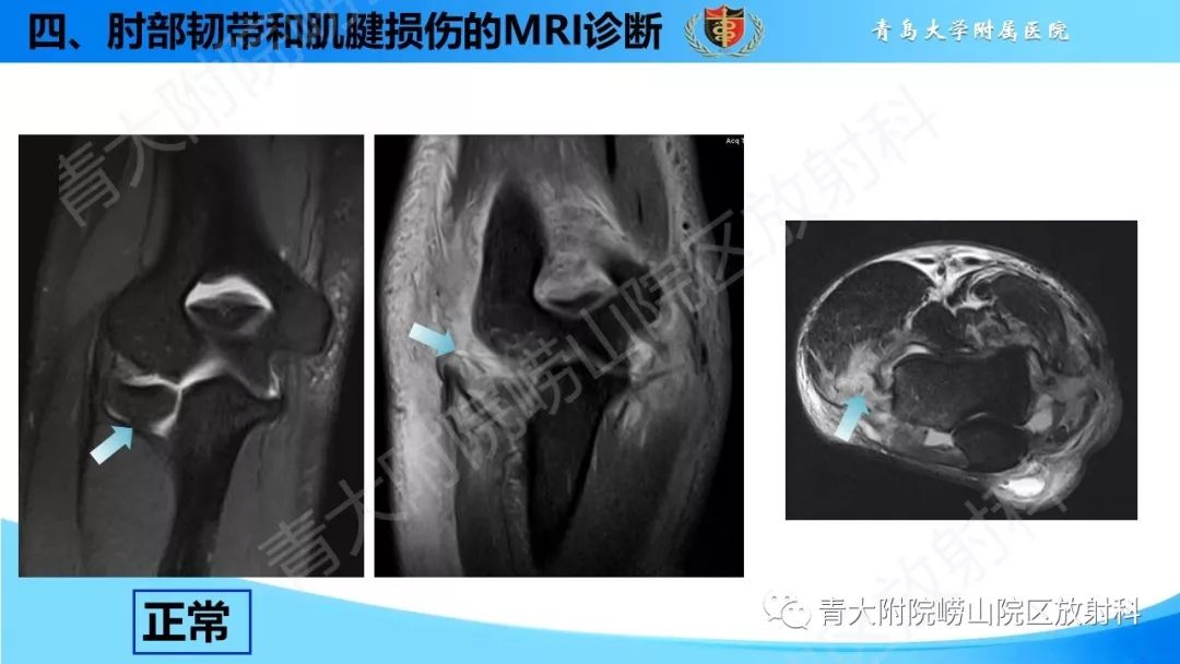 【PPT】肘部韧带和肌腱损伤的MRI诊断-39