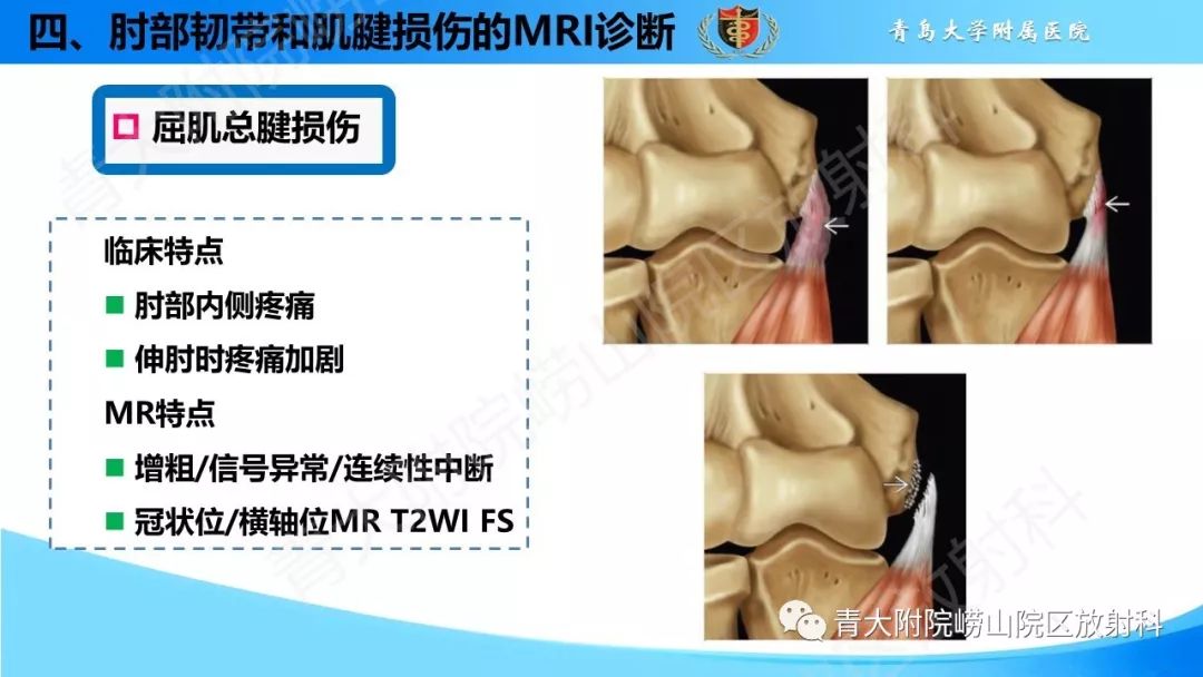 【PPT】肘部韧带和肌腱损伤的MRI诊断-40