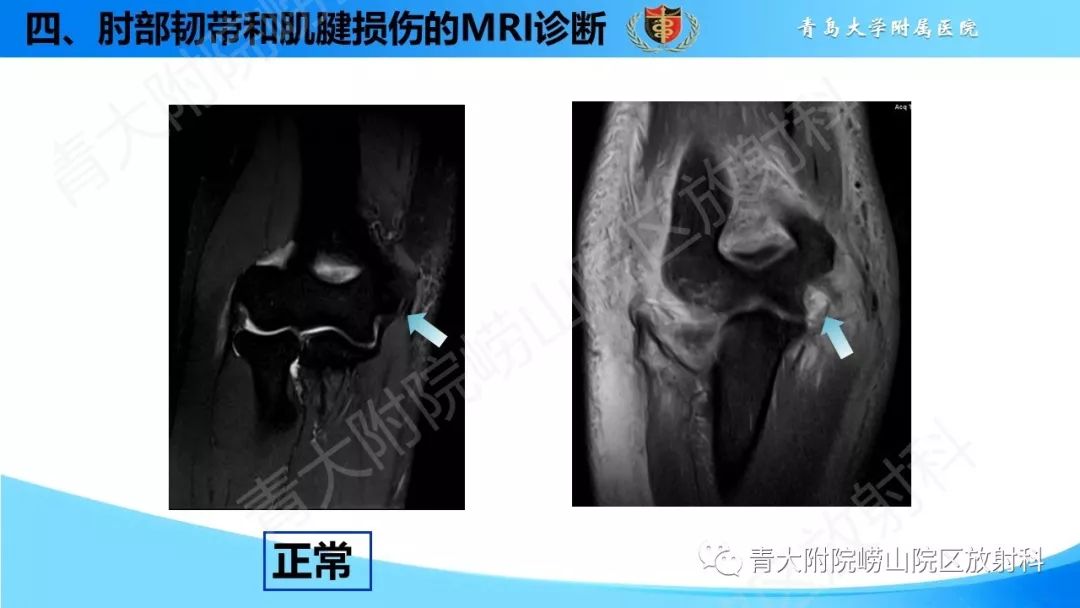【PPT】肘部韧带和肌腱损伤的MRI诊断-41