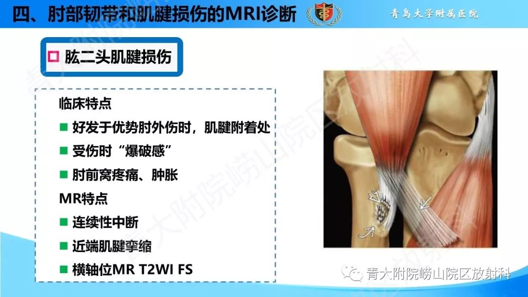 【PPT】肘部韧带和肌腱损伤的MRI诊断-42
