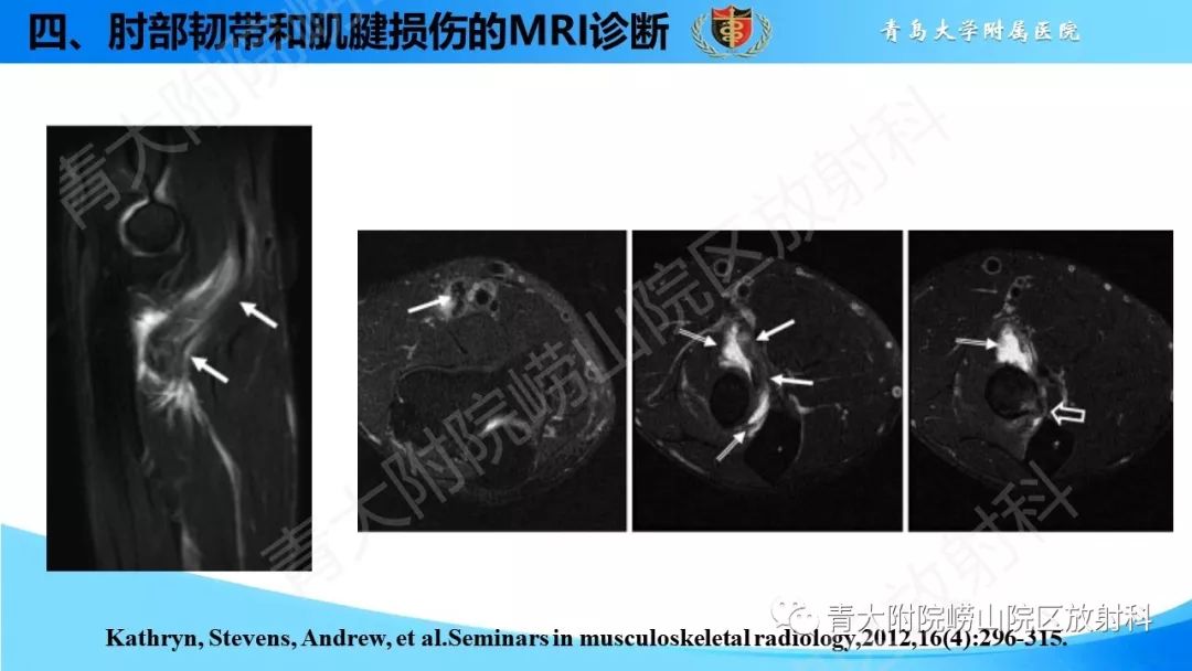 【PPT】肘部韧带和肌腱损伤的MRI诊断-44