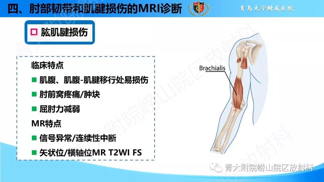 【PPT】肘部韧带和肌腱损伤的MRI诊断-45