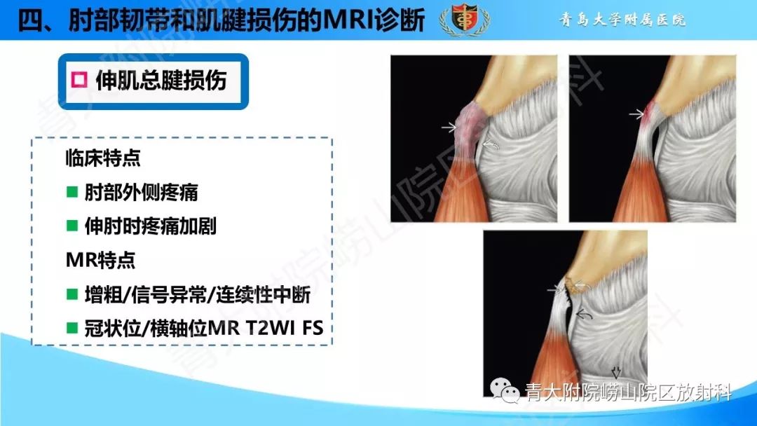 【PPT】肘部韧带和肌腱损伤的MRI诊断-47