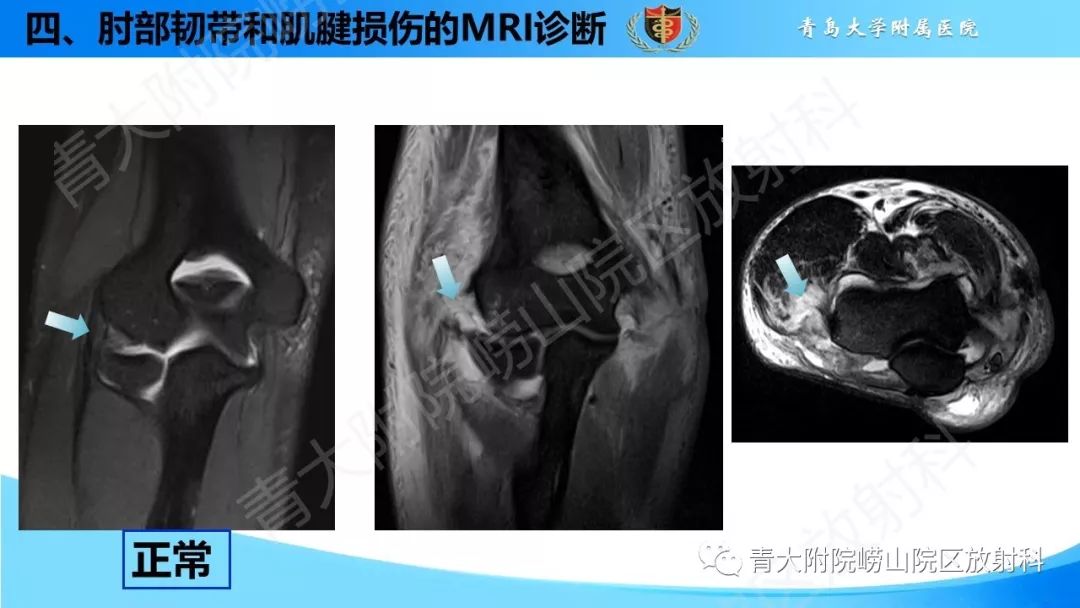【PPT】肘部韧带和肌腱损伤的MRI诊断-48