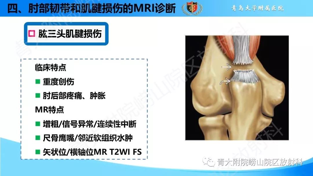 【PPT】肘部韧带和肌腱损伤的MRI诊断-49