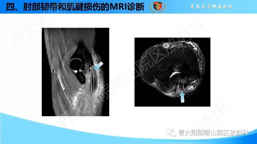 【PPT】肘部韧带和肌腱损伤的MRI诊断-50