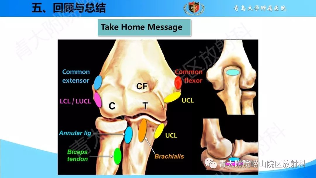 【PPT】肘部韧带和肌腱损伤的MRI诊断-51